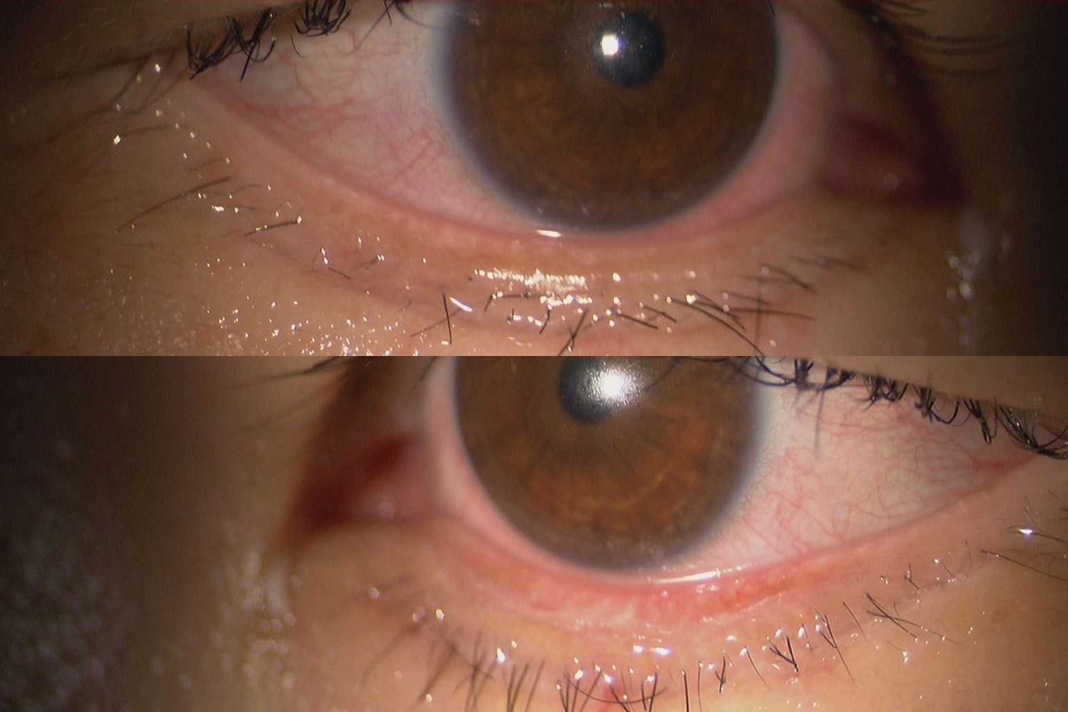 逆さまつげ内反症術後