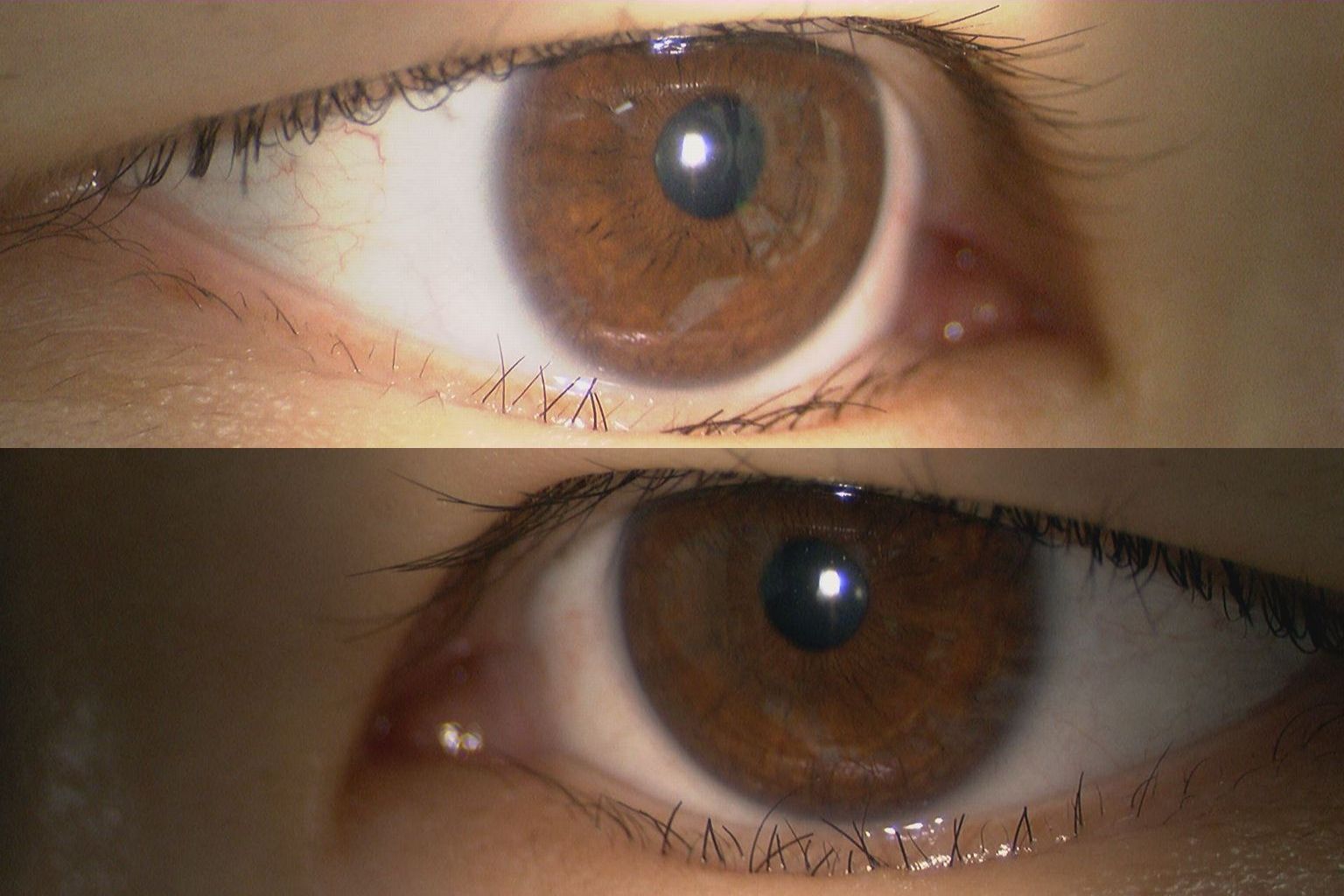 逆さまつげ内反症術前